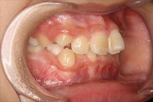 子供の出っ歯の矯正治療