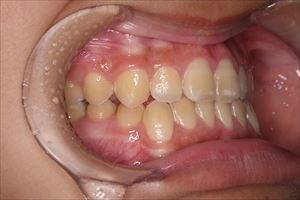 千葉市　歯の矯正治療