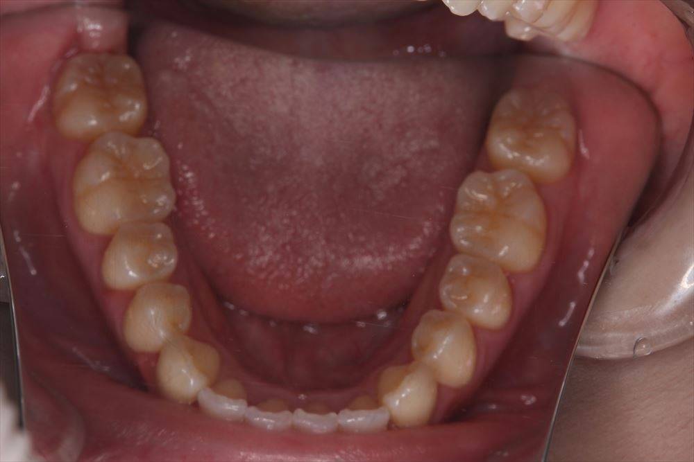 出っ歯の矯正治療