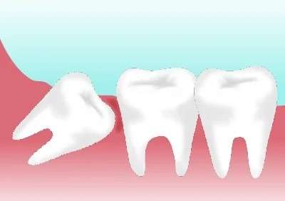 矯正治療と親知らずの抜歯